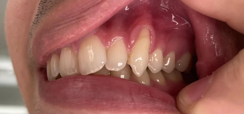 Where Are Eye Teeth Located?